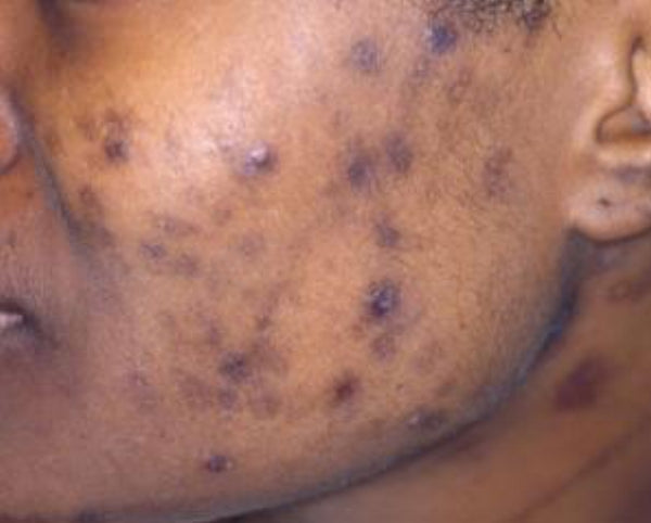 post inflammatory hyperpigmentation