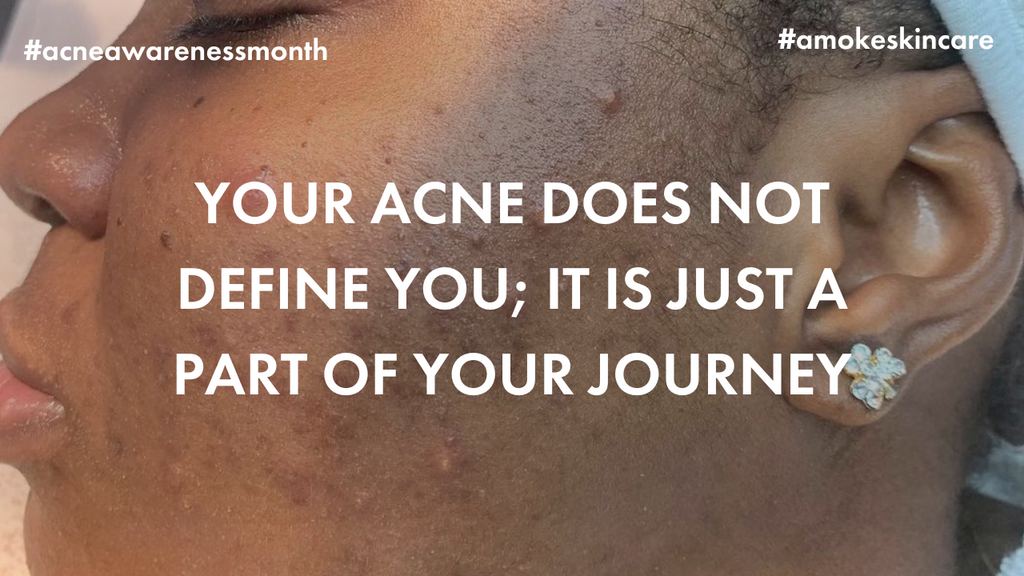 Empower Your Skin this Acne Awareness Month